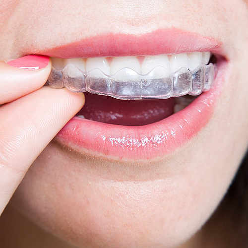 Orthodontics Aligners from SouthTampaDentalOffice.com